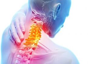 Douleur et abris dans la zone cervicale avec troisième degré d'ostéochondose