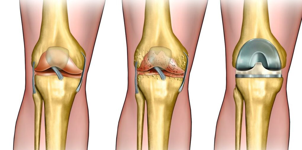 Arthrose de l'articulation du genou