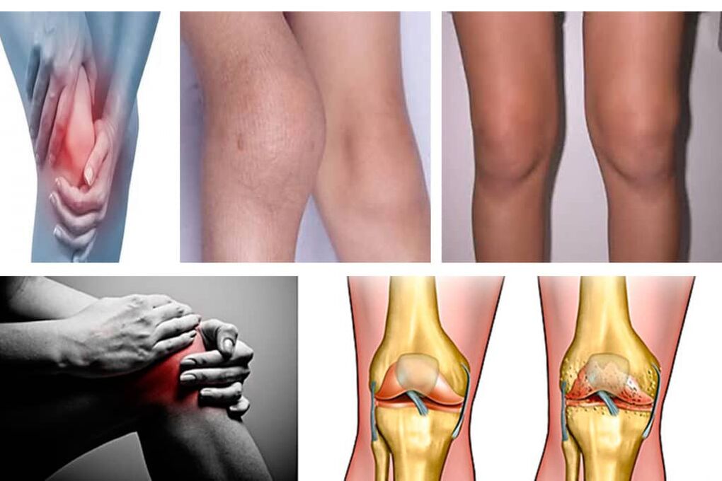 Symptômes de l'arthrose du genou